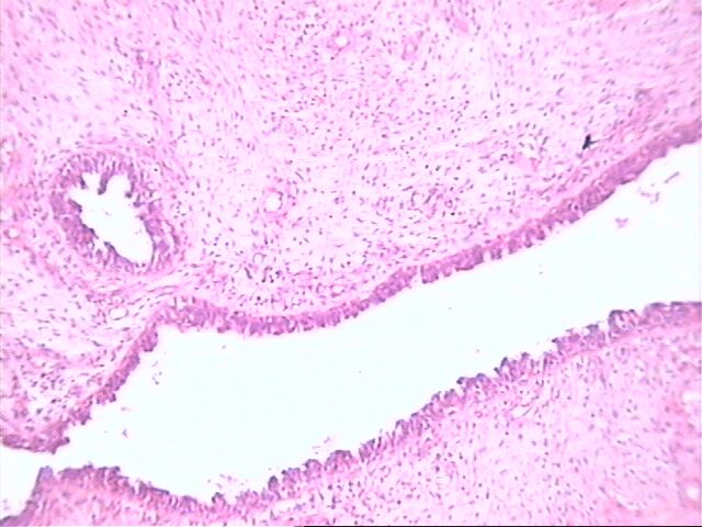 Fig. 1 tumor phyllodes benigno - <div style=